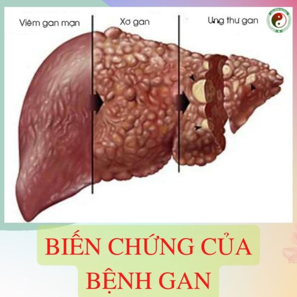 Gia Si 5kg La Cay Xa Den Kho Hoa Binh Ho Tro Dieu Tri Mau Nhiem Mo6